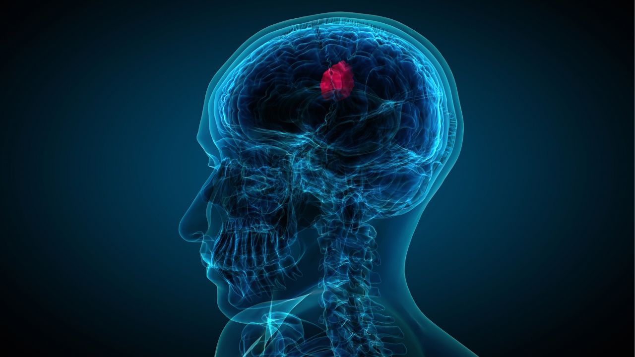 جراحی تومور استخوانی جراحی تومور استخوانی