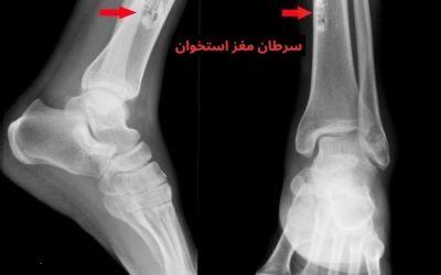 سرطان مغز استخوان چیست؟ علائم، انواع و درمان