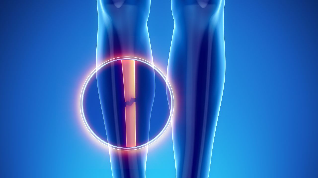 جراحی تومور استخوانی جراحی تومور استخوانی