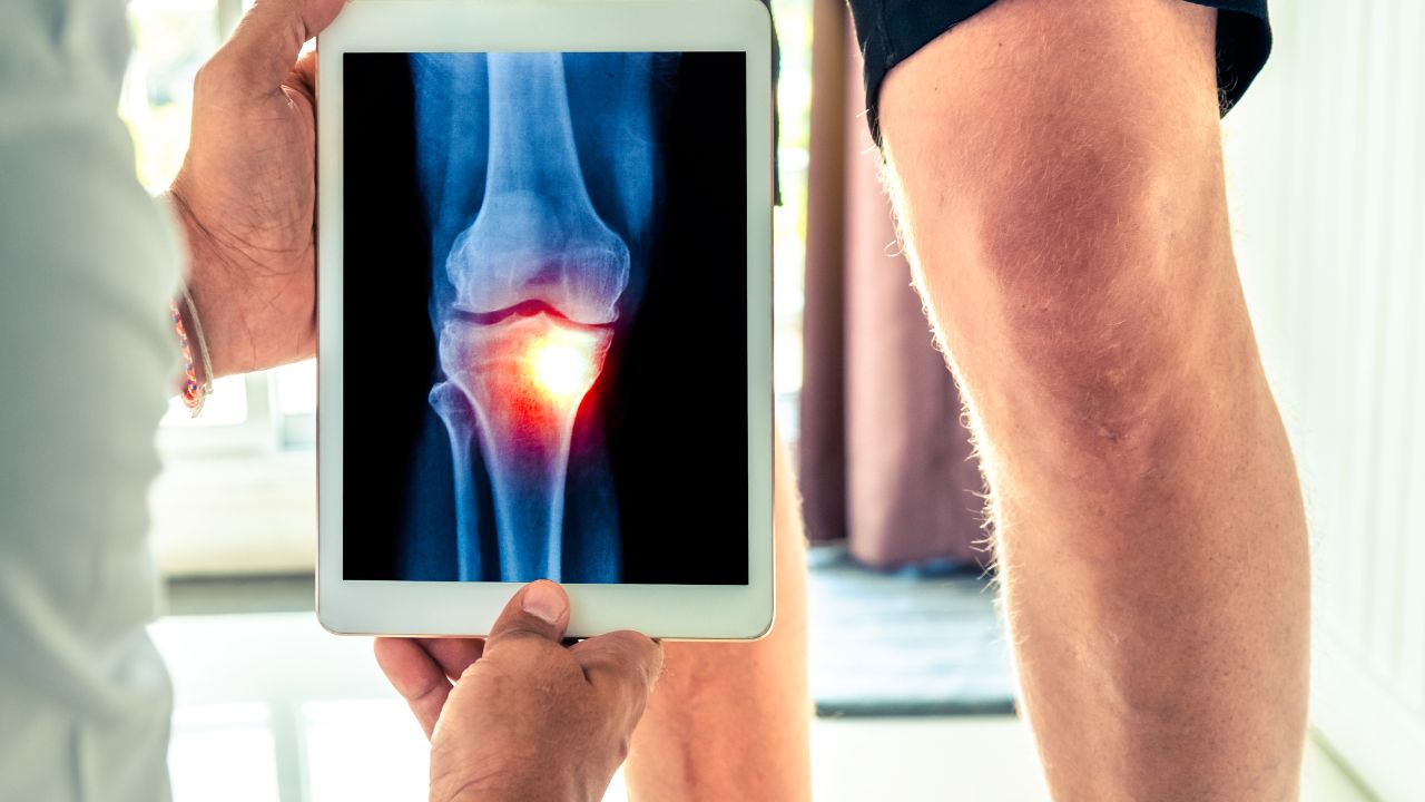 جراحی تومور استخوانی جراحی تومور استخوانی