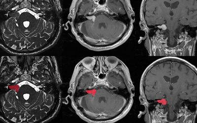 تومور شوانوما (Schwannoma tumor) چیست؟