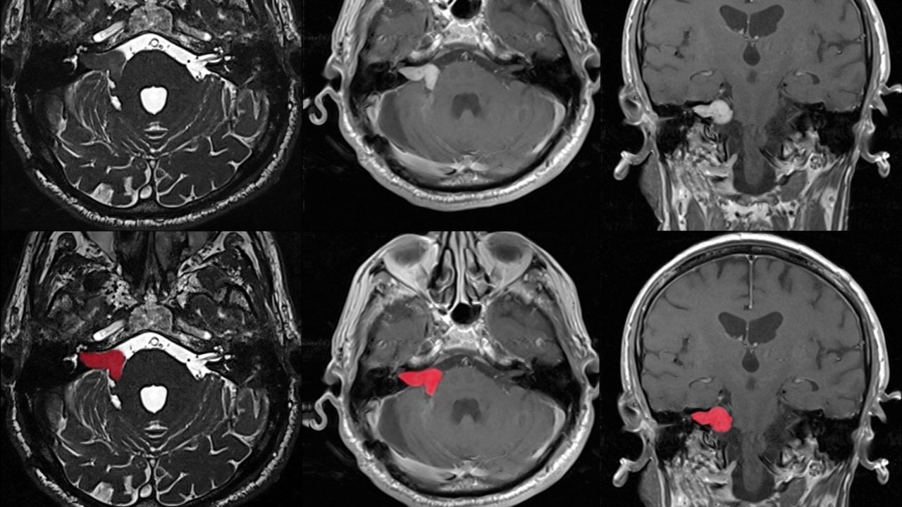 جراحی تومور استخوانی جراحی تومور استخوانی