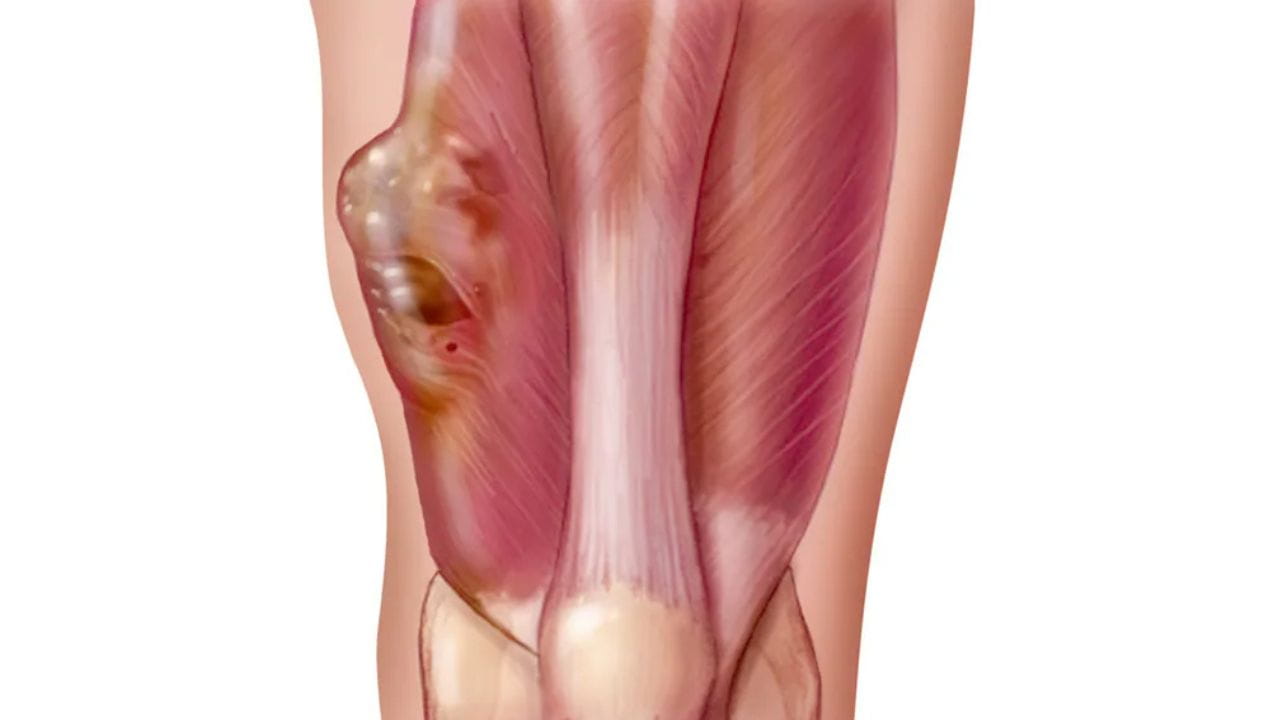 جراحی تومور استخوانی جراحی تومور استخوانی