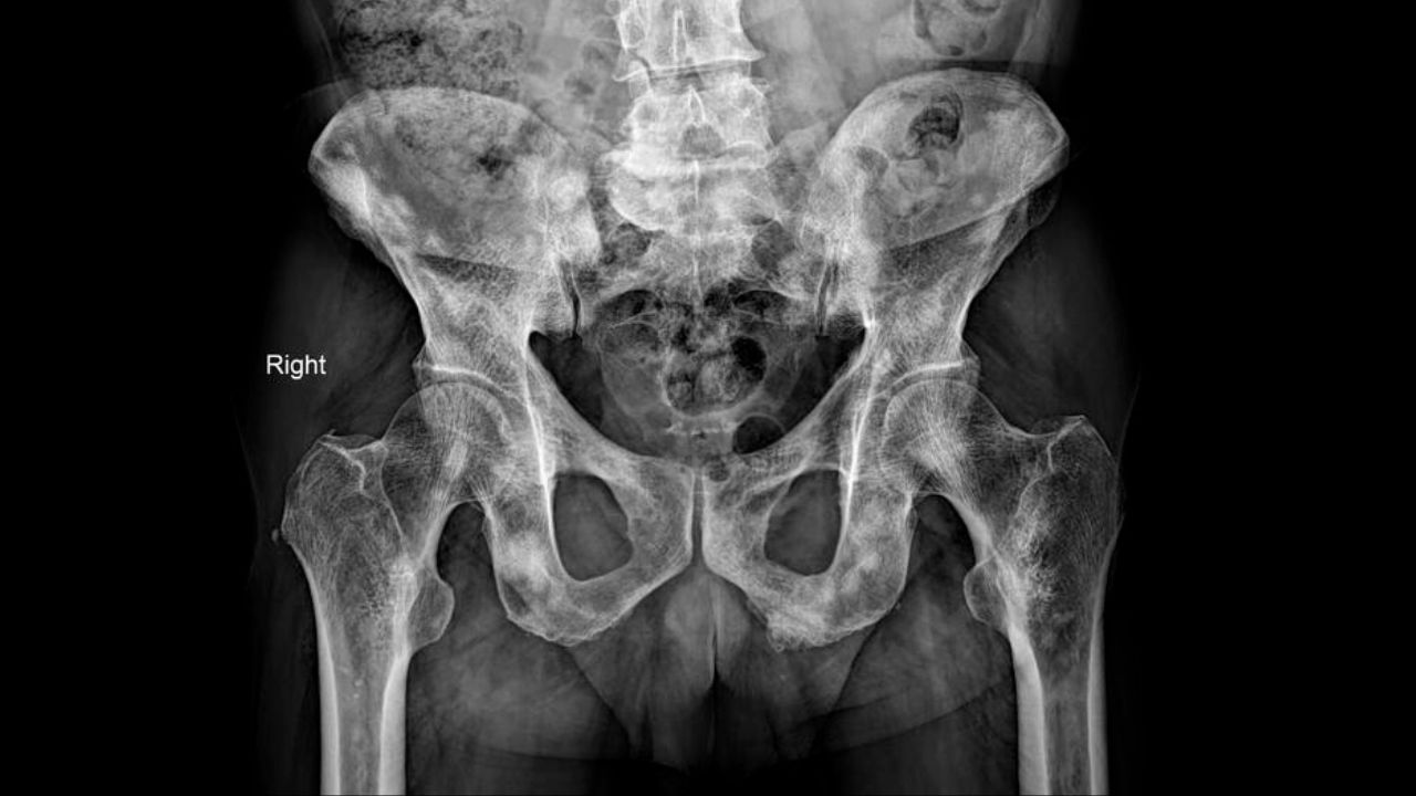 جراحی تومور استخوانی جراحی تومور استخوانی