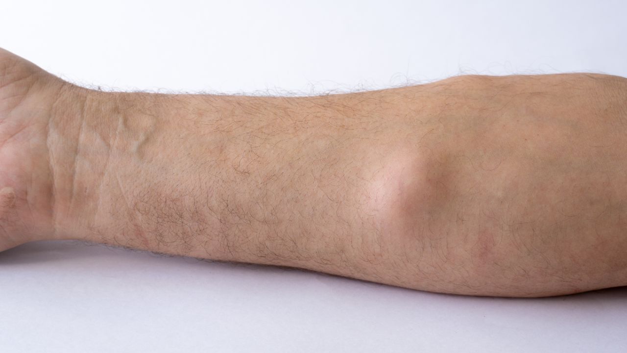 جراحی تومور استخوانی جراحی تومور استخوانی