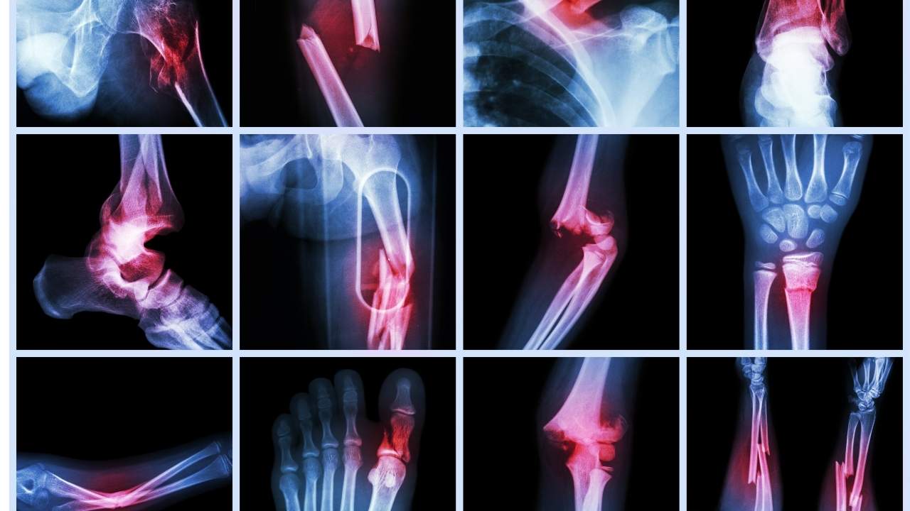 جراحی تومور استخوانی جراحی تومور استخوانی