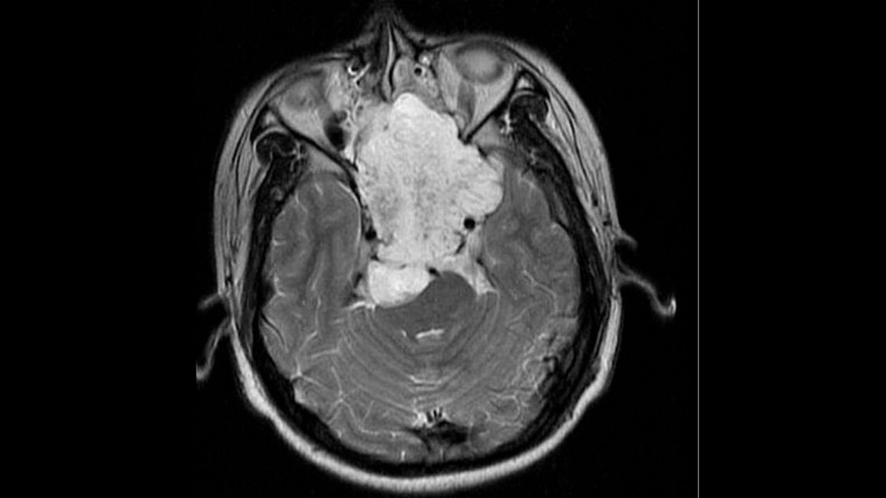 جراحی تومور استخوانی جراحی تومور استخوانی
