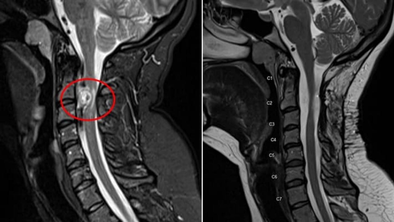 جراحی تومور استخوانی جراحی تومور استخوانی
