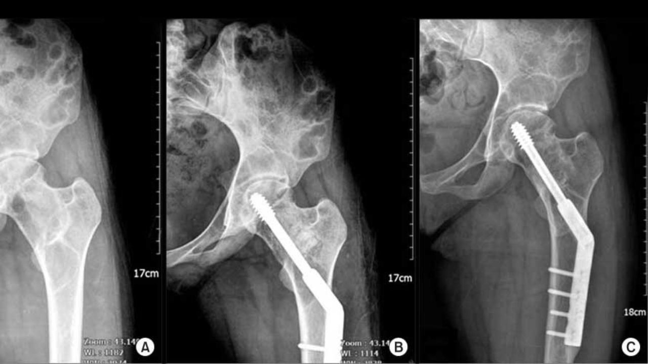 جراحی تومور استخوانی جراحی تومور استخوانی