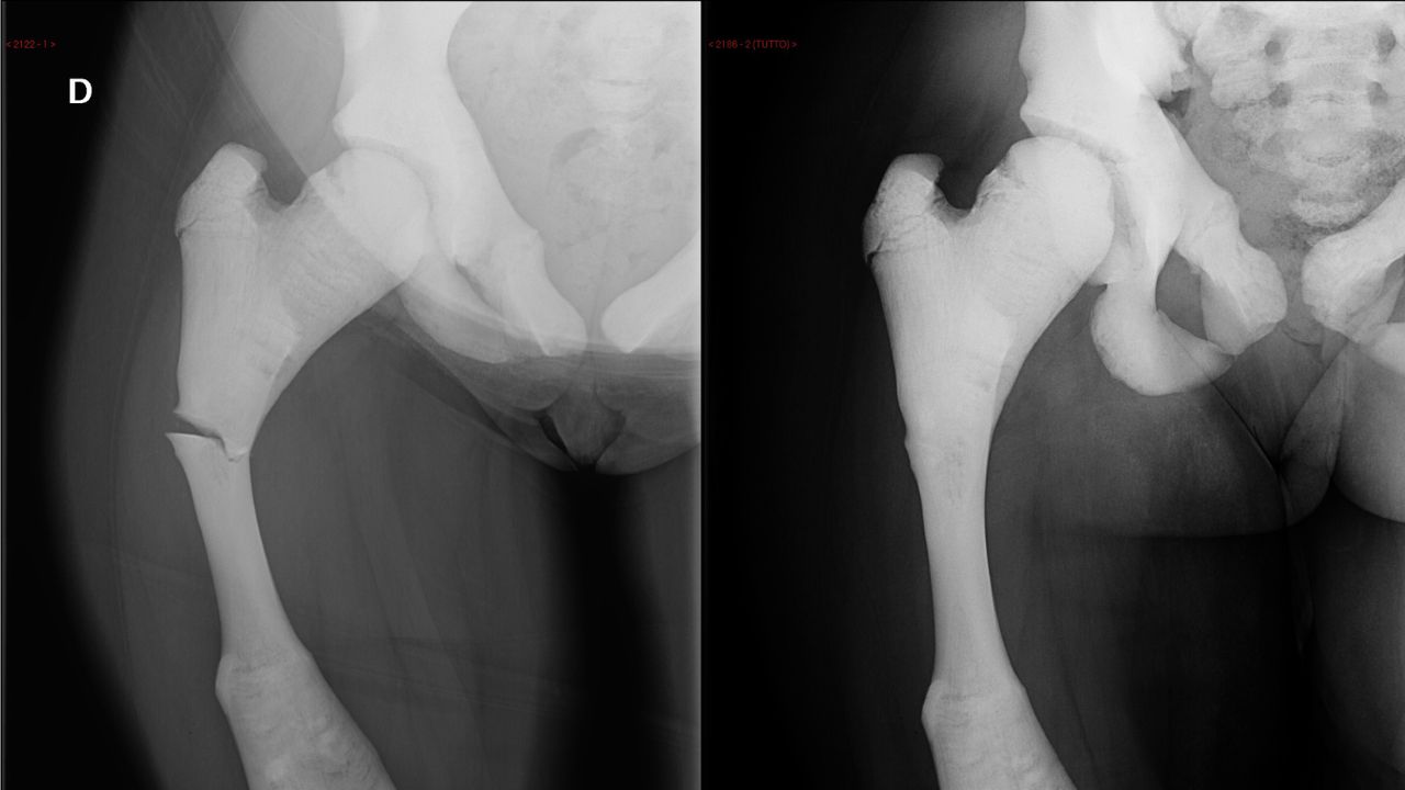جراحی تومور استخوانی جراحی تومور استخوانی