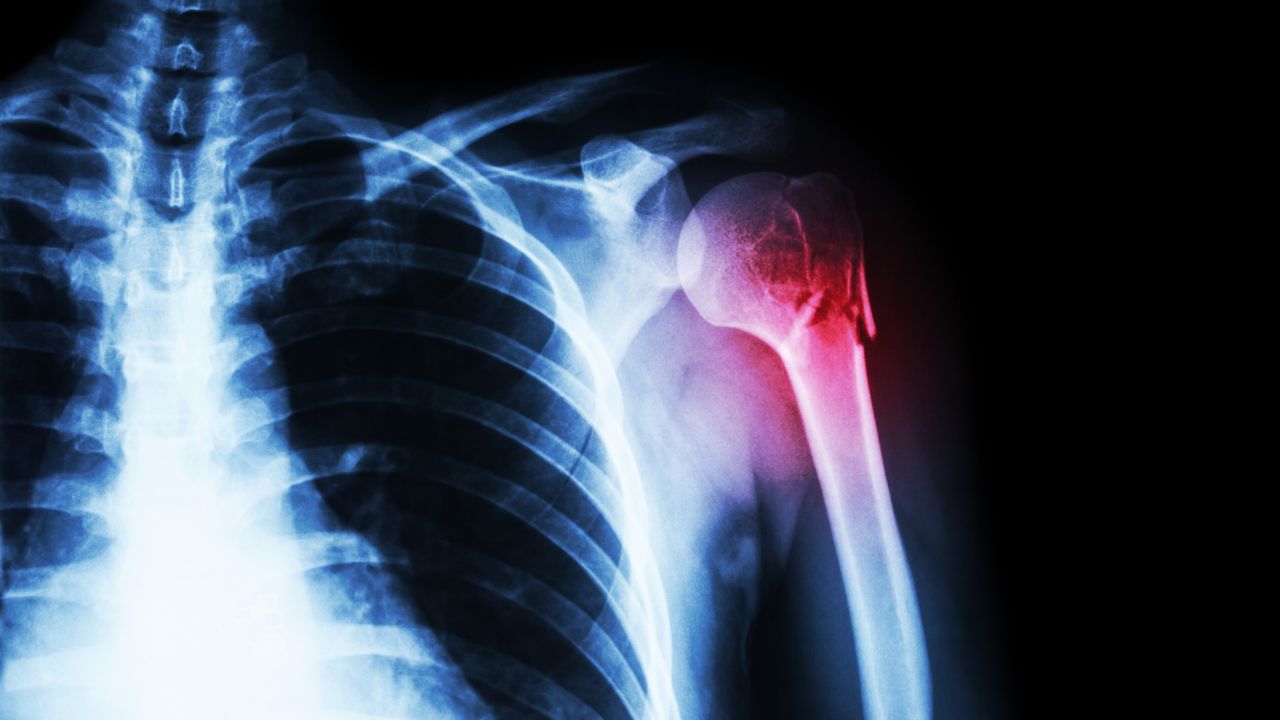 جراحی تومور استخوانی جراحی تومور استخوانی