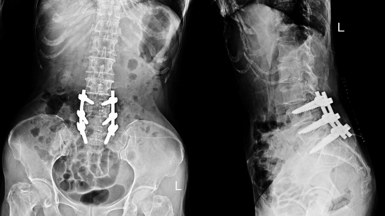 جراحی تومور استخوانی جراحی تومور استخوانی