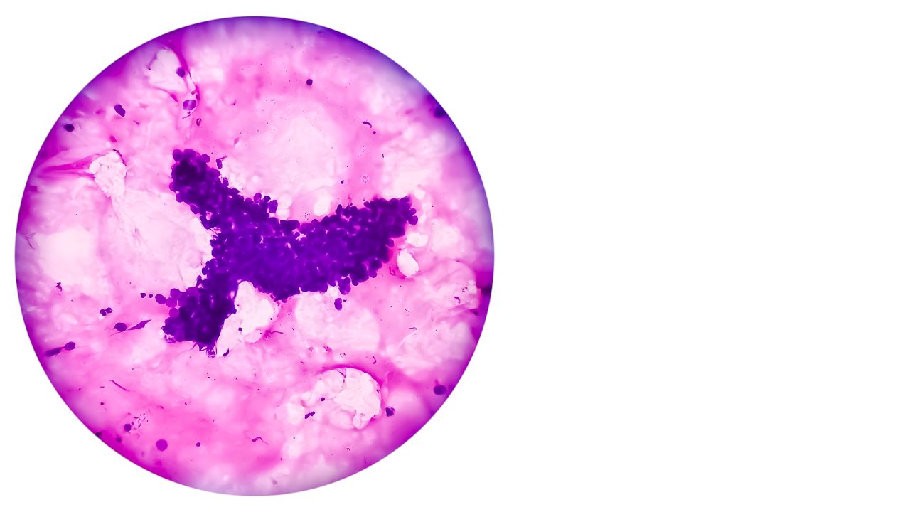 جراحی تومور استخوانی جراحی تومور استخوانی