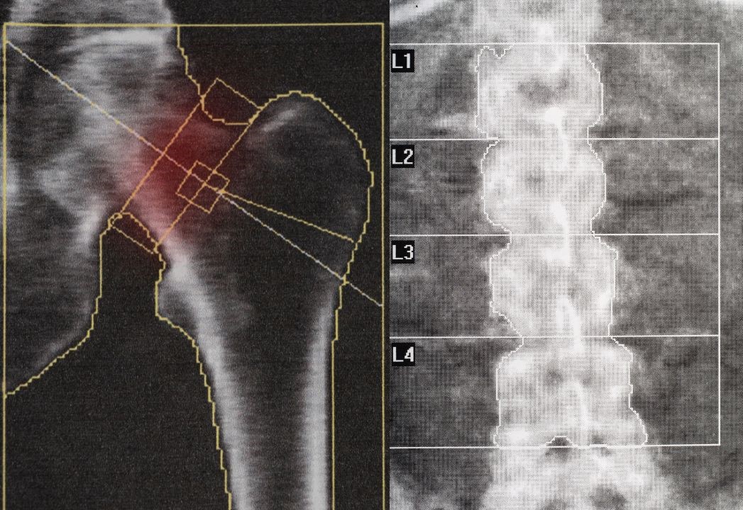 جراحی تومور استخوانی جراحی تومور استخوانی