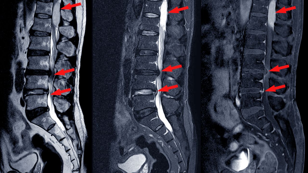 جراحی تومور استخوانی جراحی تومور استخوانی