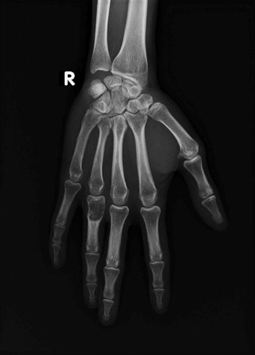 جراحی تومور استخوانی جراحی تومور استخوانی