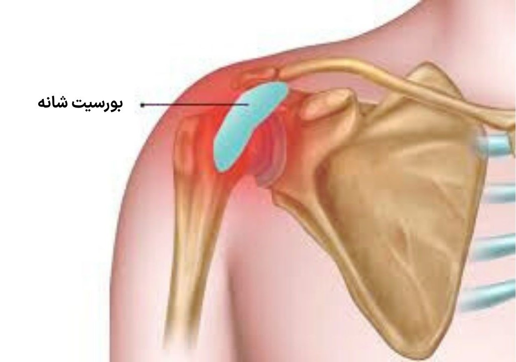جراحی تومور استخوانی جراحی تومور استخوانی