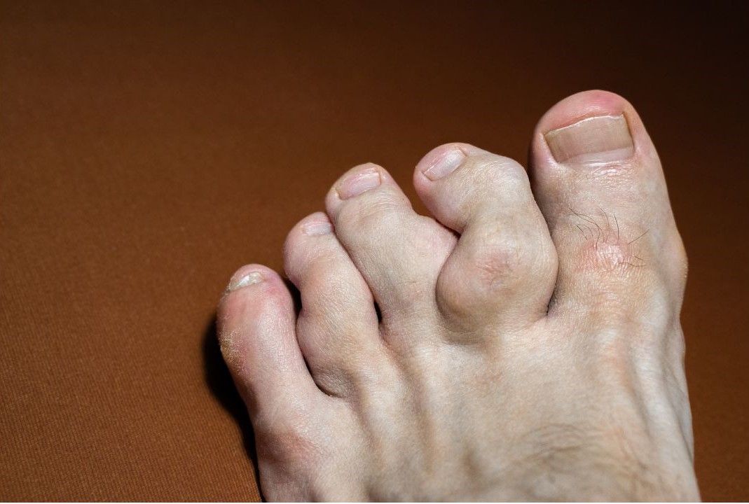 جراحی تومور استخوانی جراحی تومور استخوانی