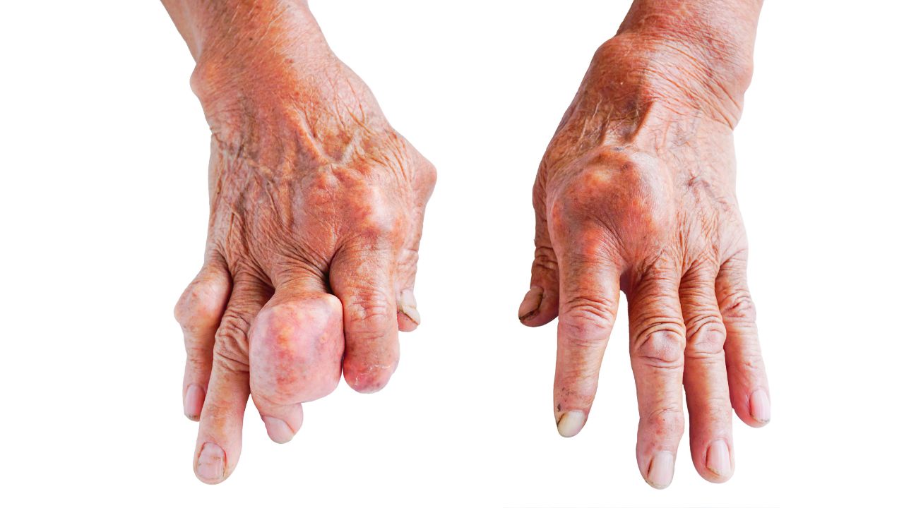 جراحی تومور استخوانی جراحی تومور استخوانی