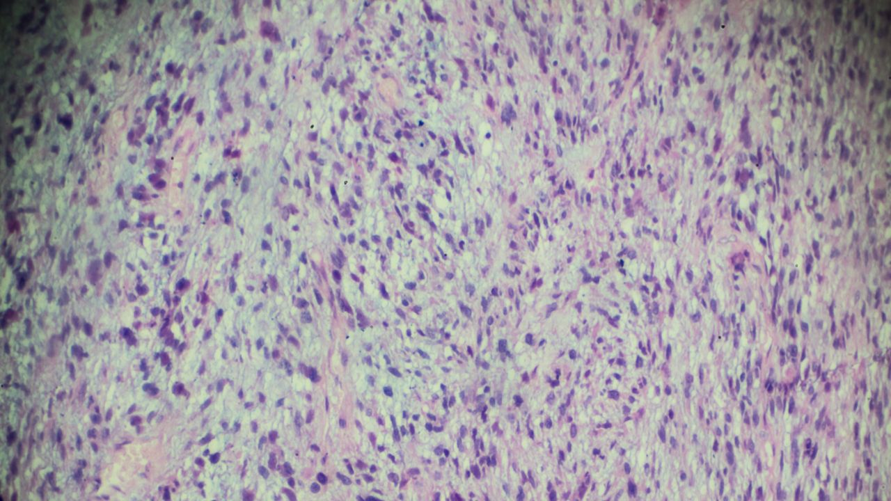 جراحی تومور استخوانی جراحی تومور استخوانی