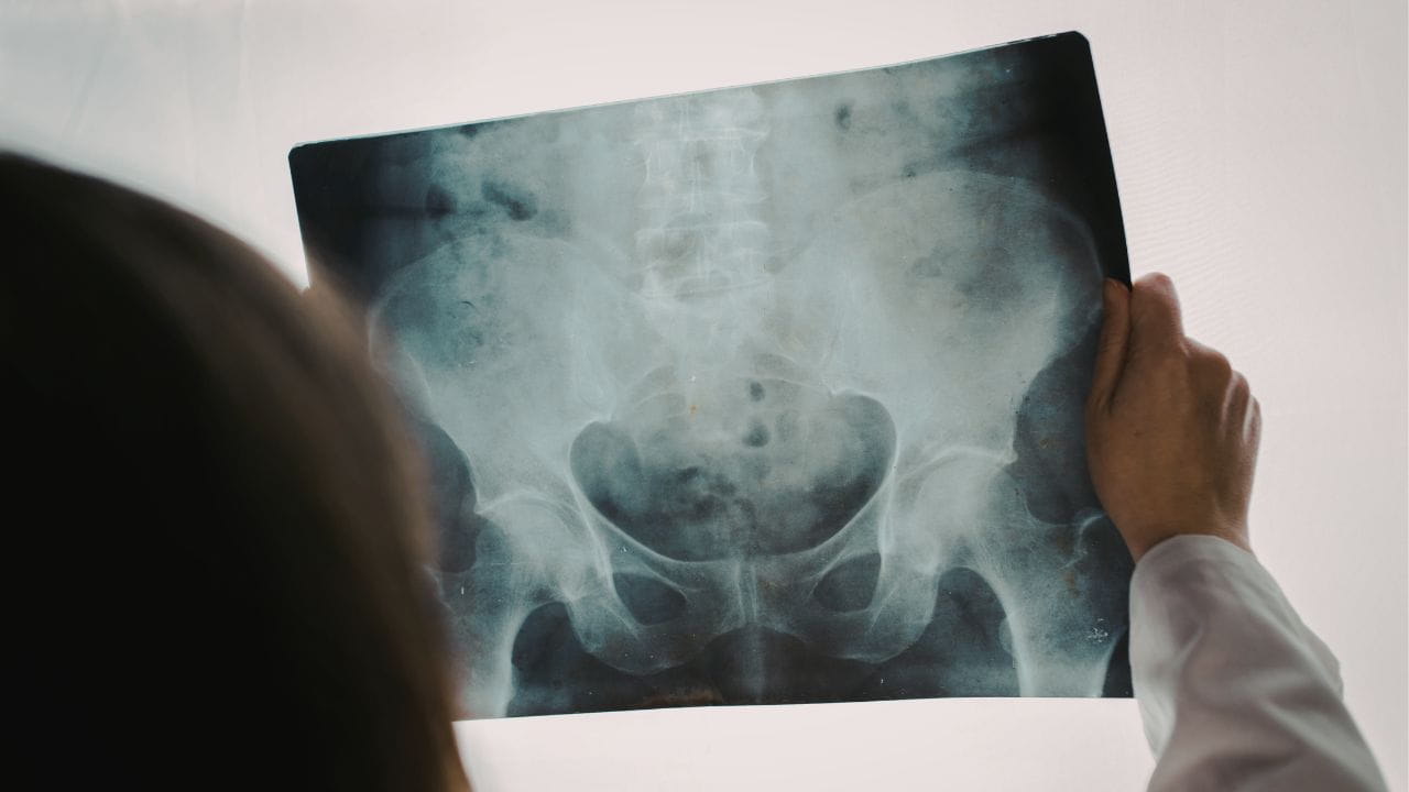 جراحی تومور استخوانی جراحی تومور استخوانی