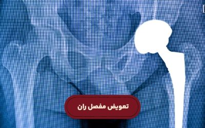 عمل تعویض مفصل ران چیست؟ شرایط، هزینه و نحوه انجام