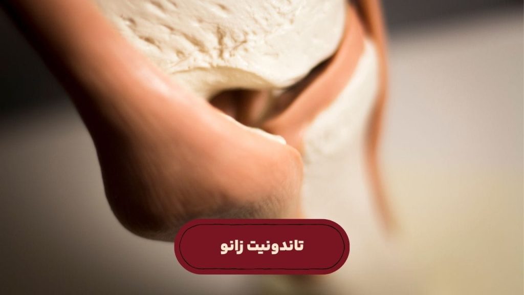 تاندونیت زانو